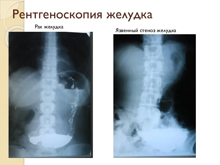 Рентгеноскопия желудка Рак желудка Язвенный стеноз желудка
