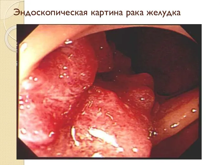 Эндоскопическая картина рака желудка