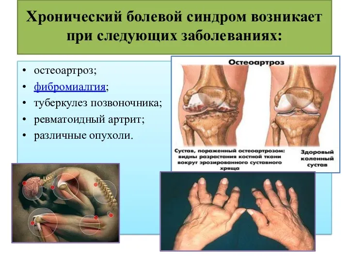 Хронический болевой синдром возникает при следующих заболеваниях: остеоартроз; фибромиалгия; туберкулез позвоночника; ревматоидный артрит; различные опухоли.