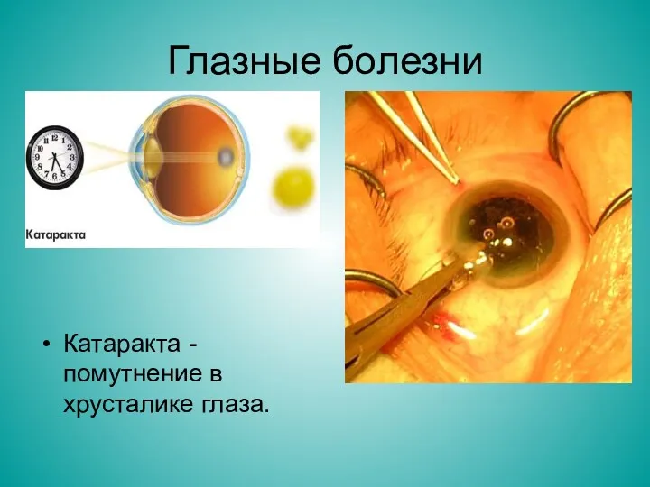 Глазные болезни Катаракта - помутнение в хрусталике глаза.