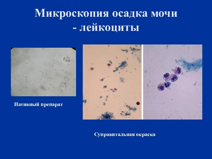 Микроскопия осадка мочи - лейкоциты Нативный препарат Суправитальная окраска