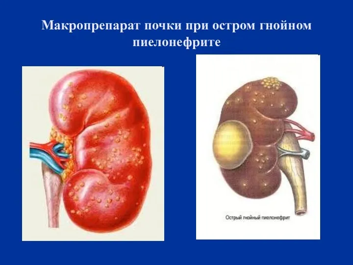 Макропрепарат почки при остром гнойном пиелонефрите