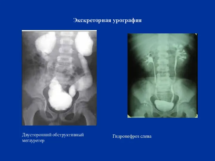 Экскреторная урография Двусторонний обструктивный мегауретер Гидронефроз слева