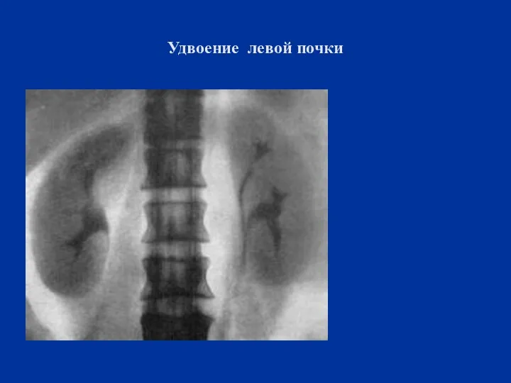 Удвоение левой почки