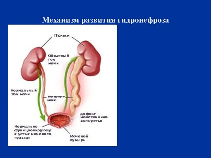 Механизм развития гидронефроза