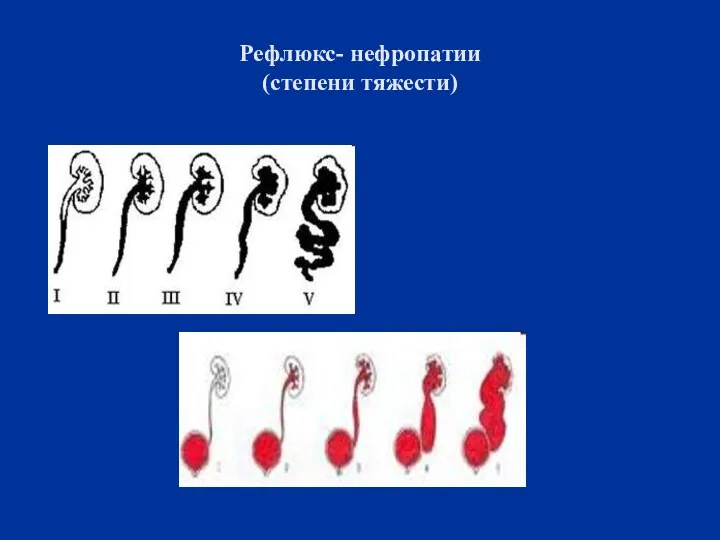 Рефлюкс- нефропатии (степени тяжести)