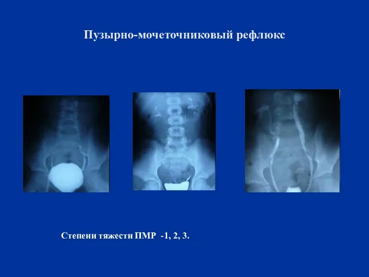 Пузырно-мочеточниковый рефлюкс Степени тяжести ПМР -1, 2, 3.