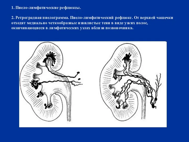 1. Пиело-лимфатические рефлюксы. 2. Ретроградная пиелограмма. Пиело-лимфатический рефлюкс. От верхней