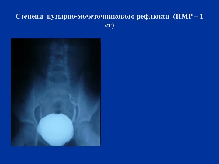 Степени пузырно-мочеточникового рефлюкса (ПМР – 1 ст)