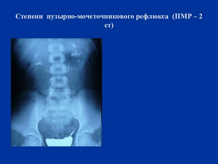 Степени пузырно-мочеточникового рефлюкса (ПМР – 2 ст)