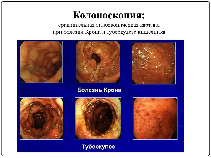Колоноскопия: сравнительная эндоскопическая картина при болезни Крона и туберкулезе кишечника