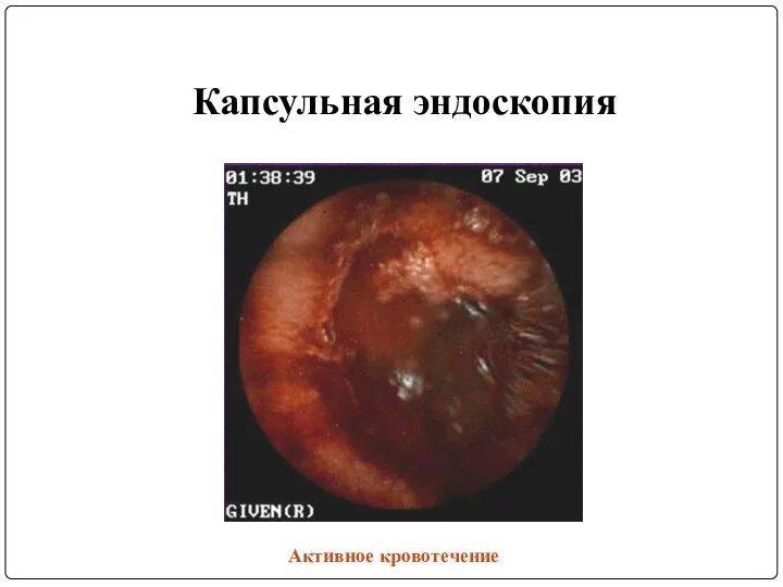 Капсульная эндоскопия Активное кровотечение