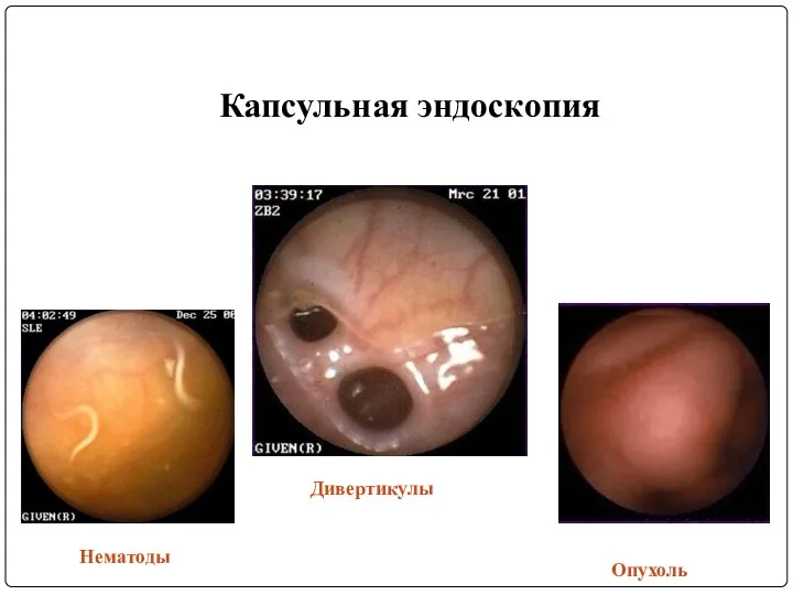 Капсульная эндоскопия Нематоды Опухоль Дивертикулы