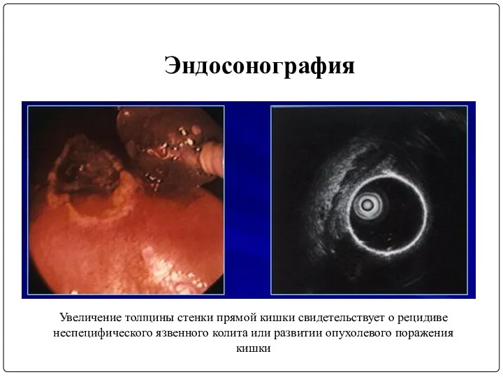 Эндосонография Увеличение толщины стенки прямой кишки свидетельствует о рецидиве неспецифического