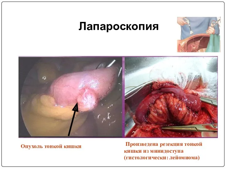 Лапароскопия Опухоль тонкой кишки Произведена резекция тонкой кишки из минидоступа (гистологически: лейомиома)