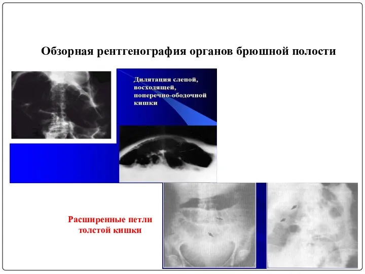 Обзорная рентгенография органов брюшной полости Расширенные петли толстой кишки