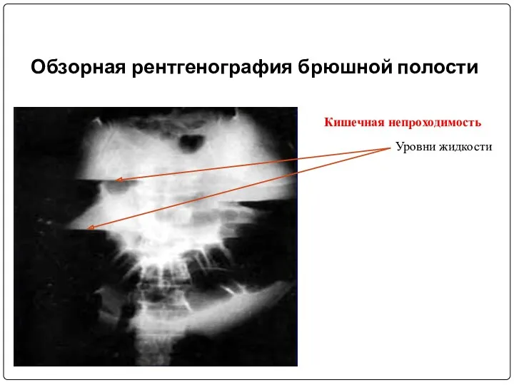 Обзорная рентгенография брюшной полости Уровни жидкости Кишечная непроходимость
