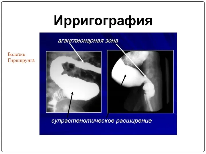 Ирригография Болезнь Гиршпрунга