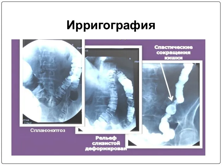 Ирригография