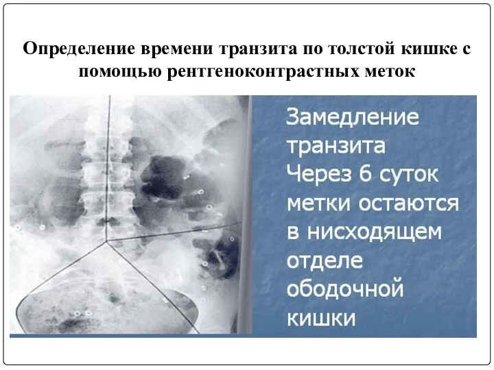 Определение времени транзита по толстой кишке с помощью рентгеноконтрастных меток