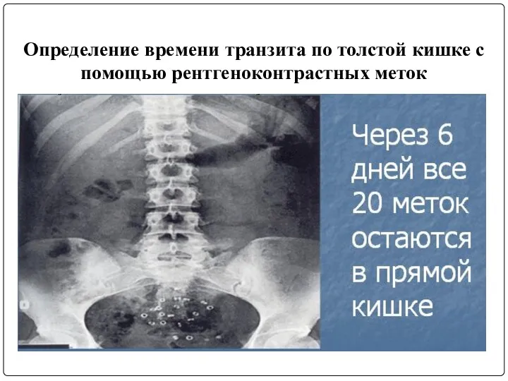 Определение времени транзита по толстой кишке с помощью рентгеноконтрастных меток