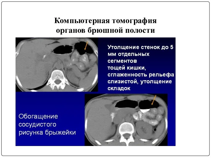 Компьютерная томография органов брюшной полости