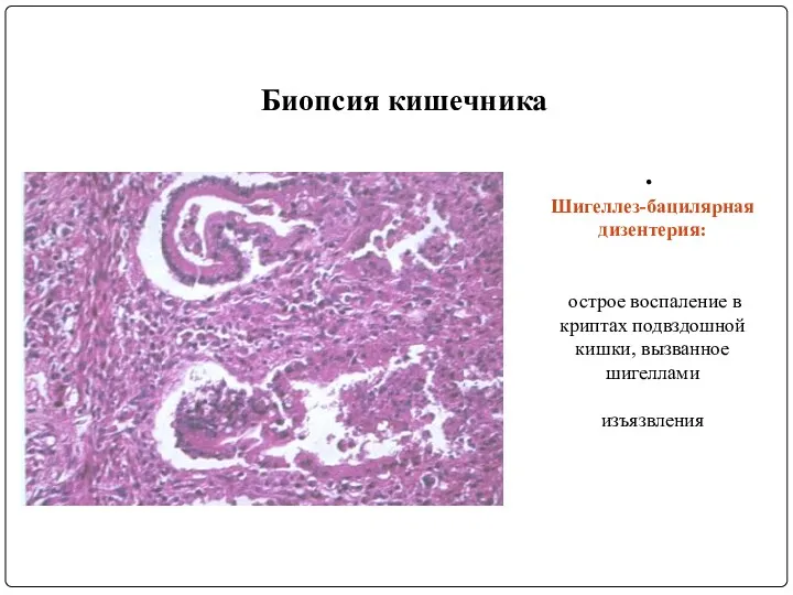Биопсия кишечника Шигеллез-бацилярная дизентерия: острое воспаление в криптах подвздошной кишки, вызванное шигеллами изъязвления
