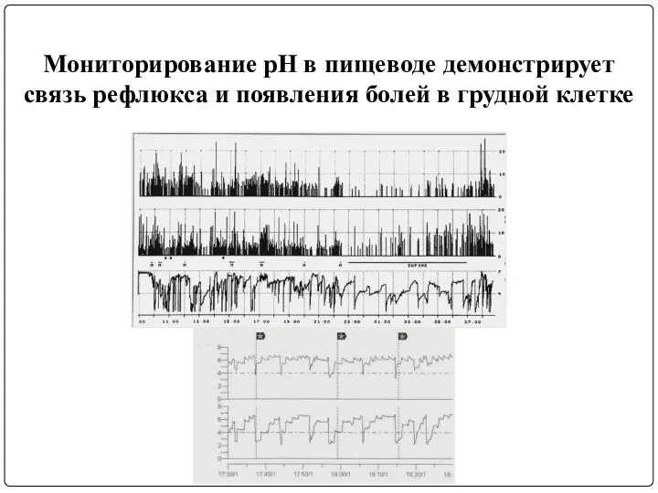 Мониторирование рН в пищеводе демонстрирует связь рефлюкса и появления болей в грудной клетке