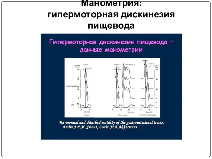 Манометрия: гипермоторная дискинезия пищевода
