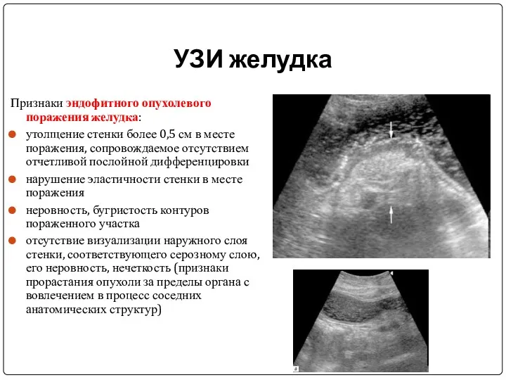 УЗИ желудка Признаки эндофитного опухолевого поражения желудка: утолщение стенки более