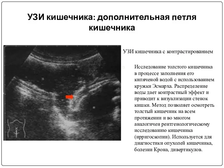 УЗИ кишечника: дополнительная петля кишечника УЗИ кишечника с контрастированием Исследование