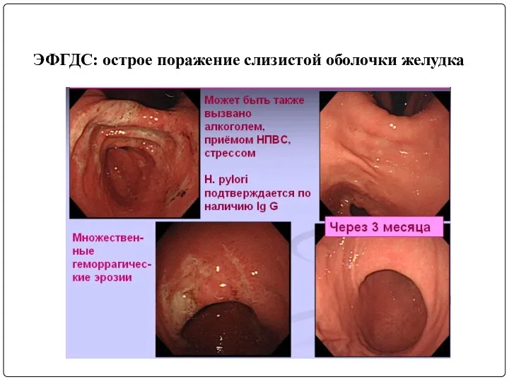 ЭФГДС: острое поражение слизистой оболочки желудка