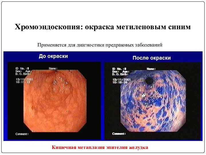 Хромоэндоскопия: окраска метиленовым синим Кишечная метаплазия эпителия желудка Применяется для диагностики предраковых заболеваний