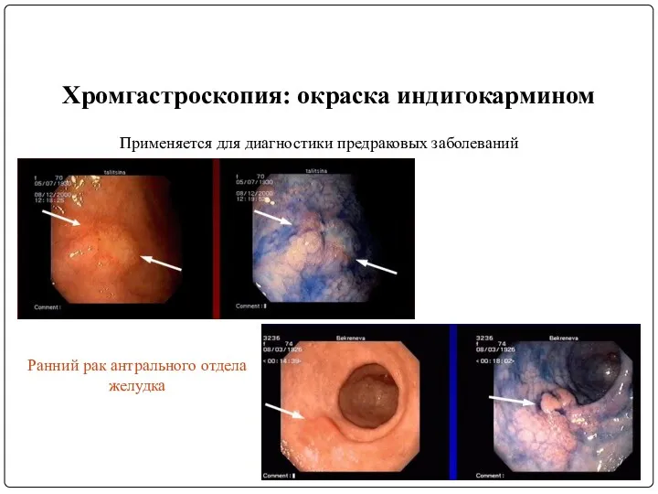 Хромгастроскопия: окраска индигокармином Ранний рак антрального отдела желудка Применяется для диагностики предраковых заболеваний