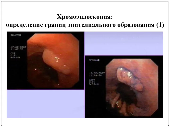 Хромоэндоскопия: определение границ эпителиального образования (1)