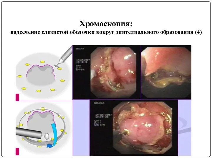 Хромоскопия: надсечение слизистой оболочки вокруг эпителиального образования (4)
