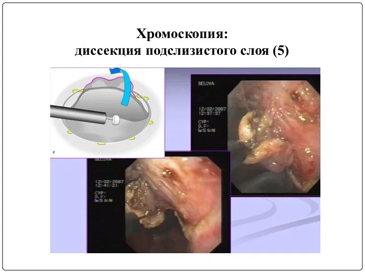 Хромоскопия: диссекция подслизистого слоя (5)