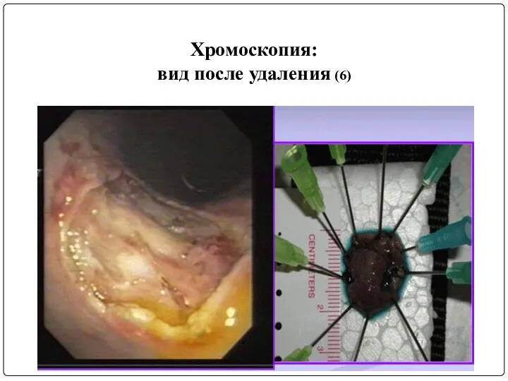 Хромоскопия: вид после удаления (6)