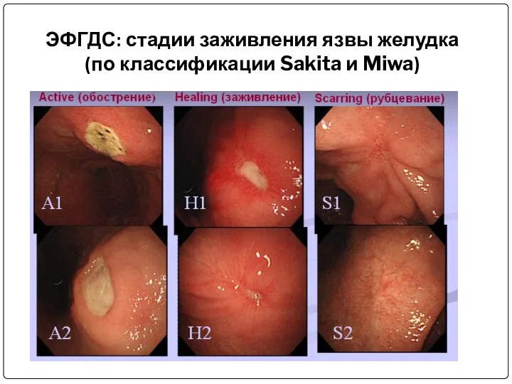 ЭФГДС: стадии заживления язвы желудка (по классификации Sakita и Miwa)