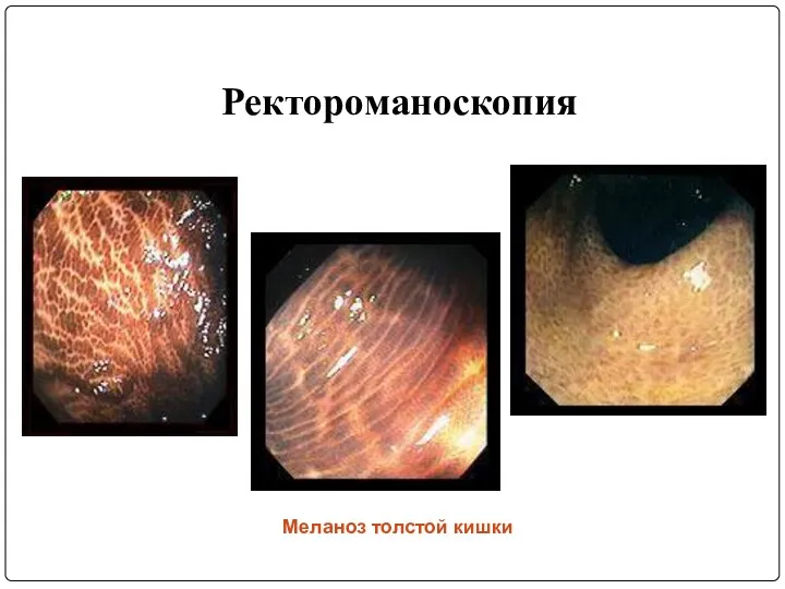 Меланоз толстой кишки Ректороманоскопия