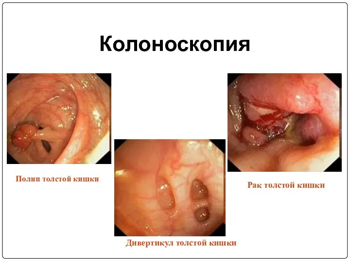 Колоноскопия Полип толстой кишки Дивертикул толстой кишки Рак толстой кишки