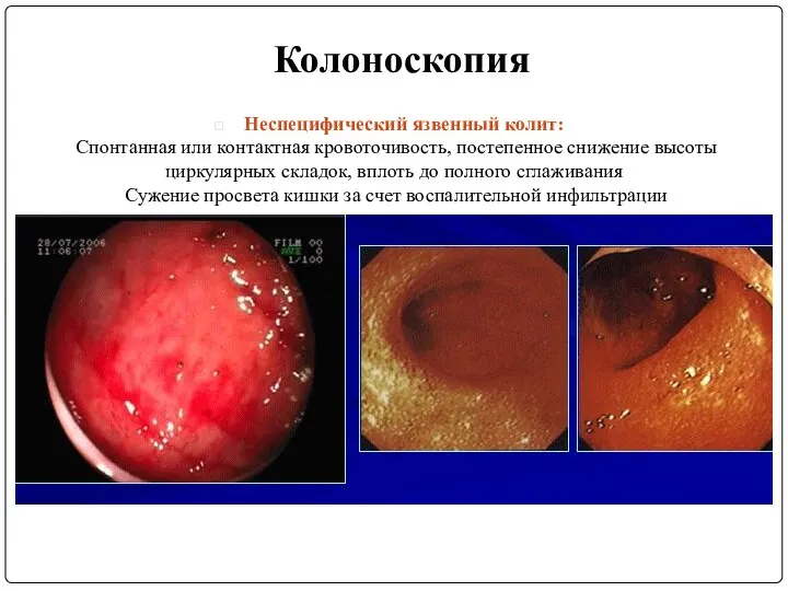 Колоноскопия Неспецифический язвенный колит: Спонтанная или контактная кровоточивость, постепенное снижение