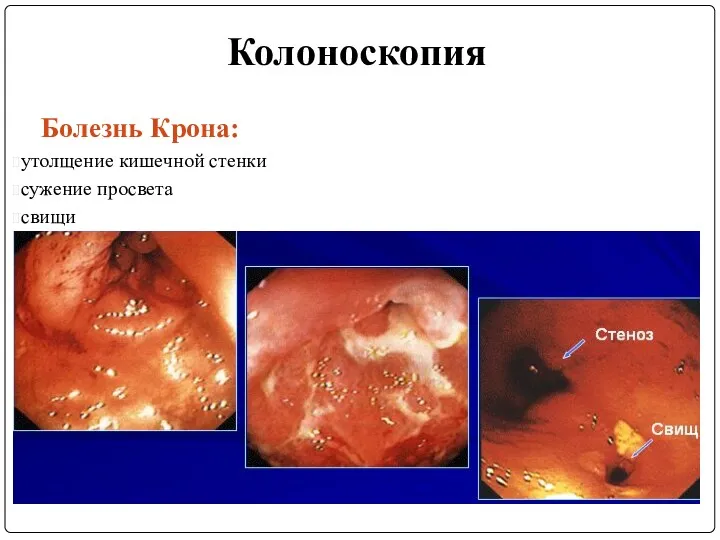 Колоноскопия Болезнь Крона: утолщение кишечной стенки сужение просвета свищи