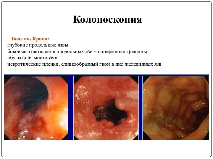 Колоноскопия Болезнь Крона: глубокие продольные язвы боковые ответвления продольных язв