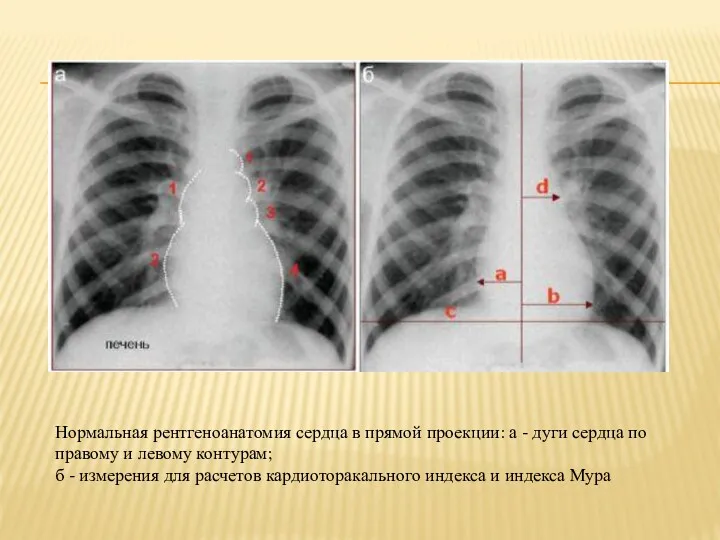 Нормальная рентгеноанатомия сердца в прямой проекции: а - дуги сердца по правому и