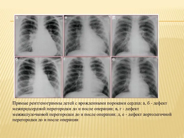 Прямые рентгенограммы детей с врожденными пороками сердца: а, б -