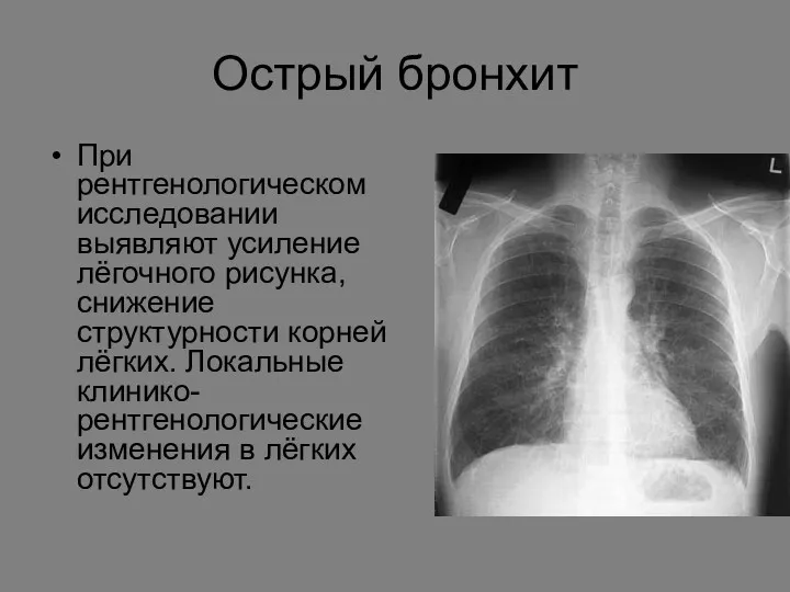 Острый бронхит При рентгенологическом исследовании выявляют усиление лёгочного рисунка, снижение структурности корней лёгких.