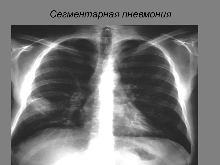 Сегментарная пневмония