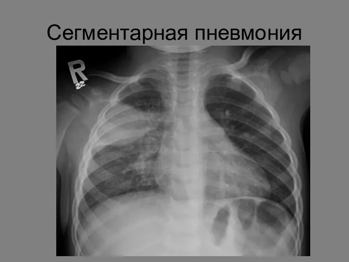 Сегментарная пневмония