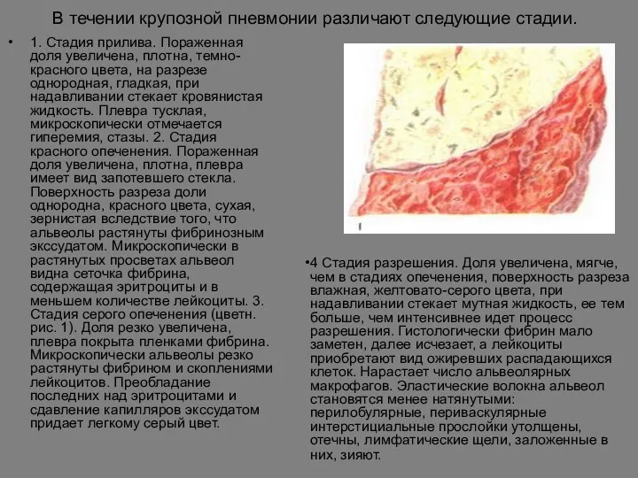 В течении крупозной пневмонии различают следующие стадии. 1. Стадия прилива. Пораженная доля увеличена,